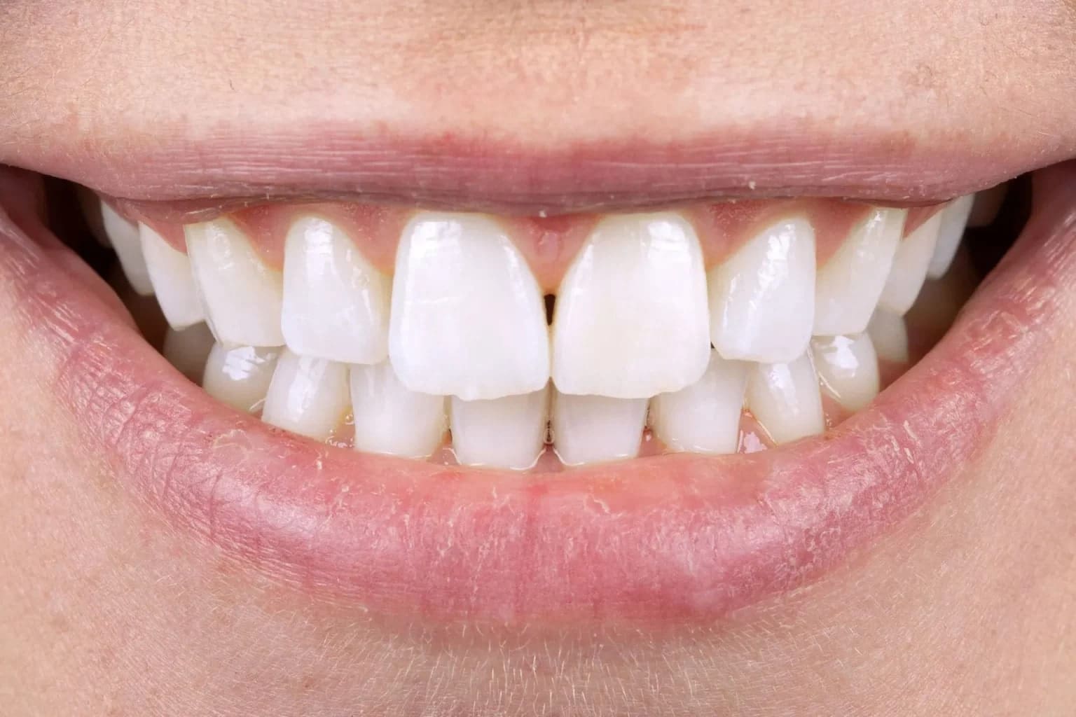 Boutique-whitening-kensington-court-clinic-whitening-after-image-min