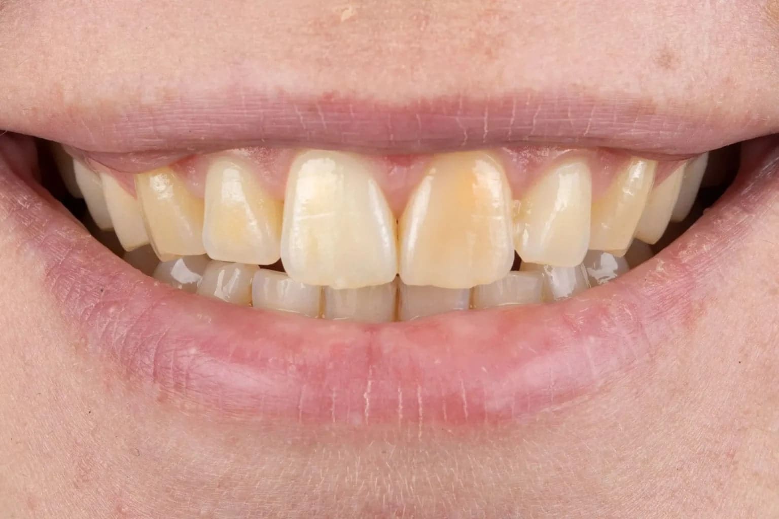 Boutique-whitening-kensington-court-clinic-whitening-before-image-min