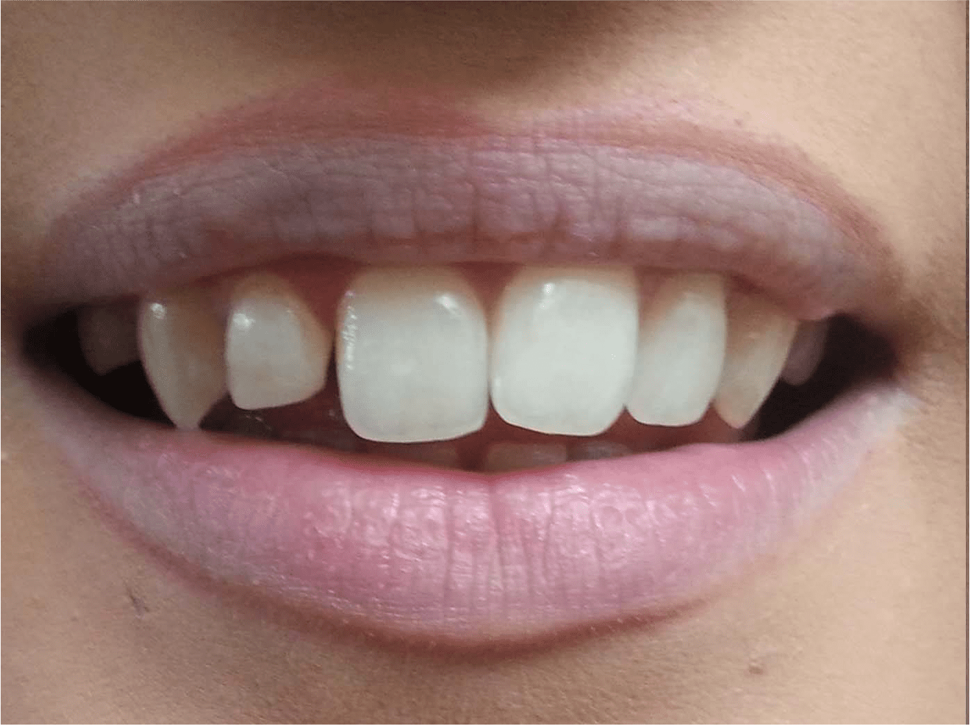 Composite Veneers - Kensington Court Clinic - composite veneers Before