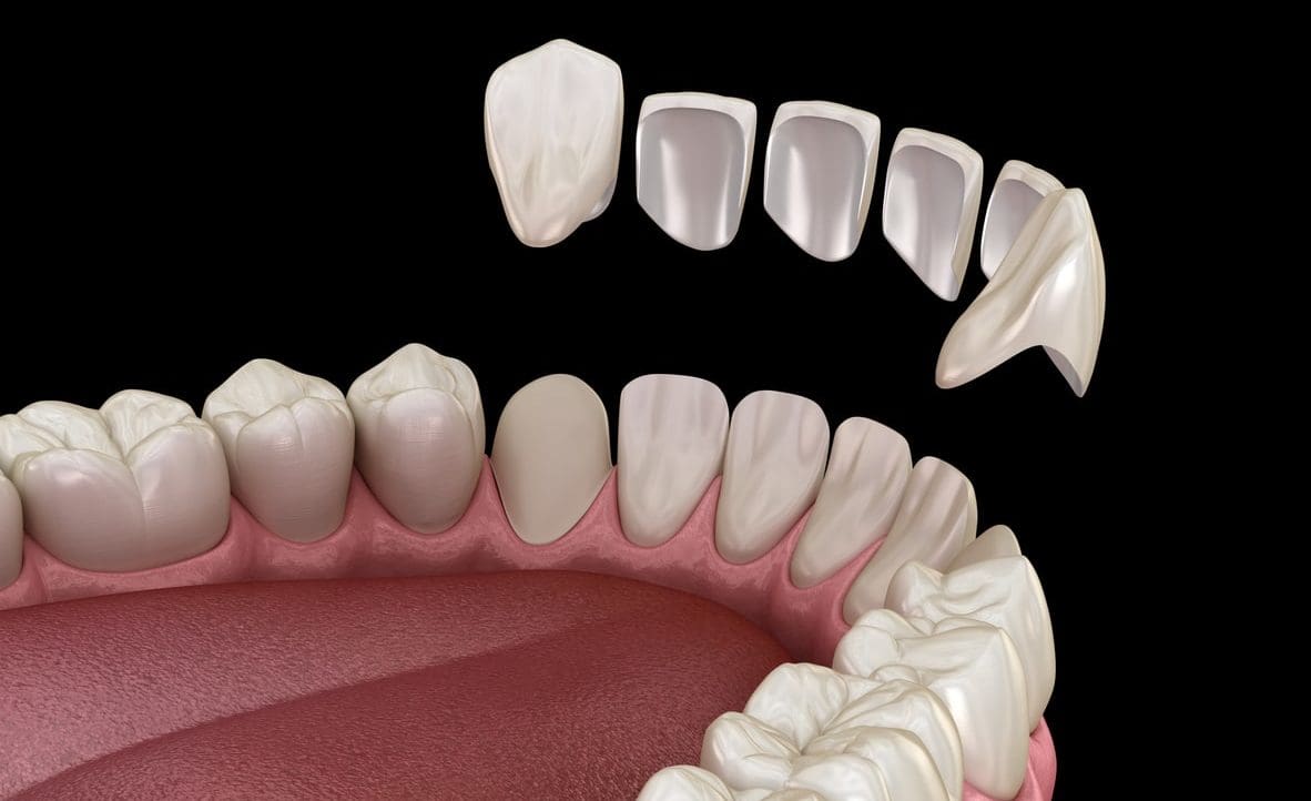 Composite Veneers - Kensington Court Clinic - example of indirect comp veneers