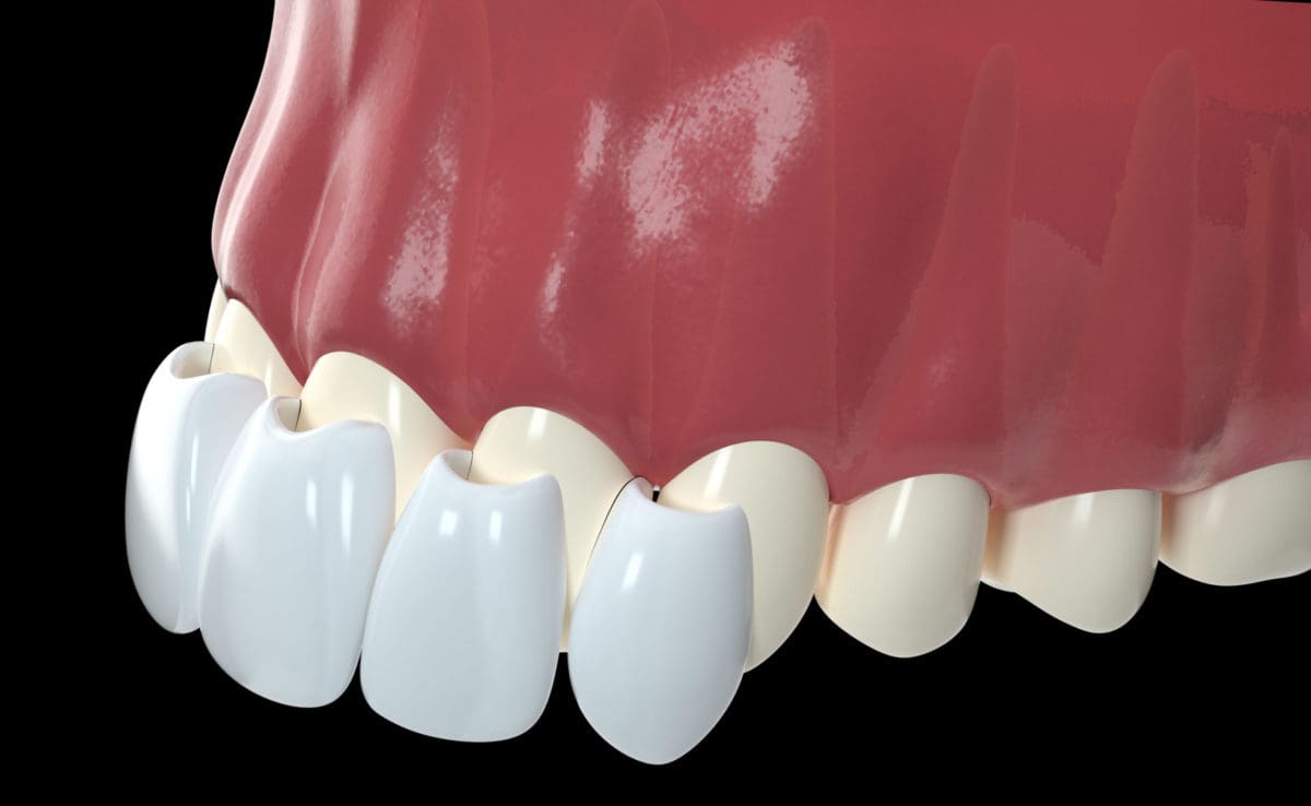 Composite Veneers Kensington Court Clinic Private Dentistry