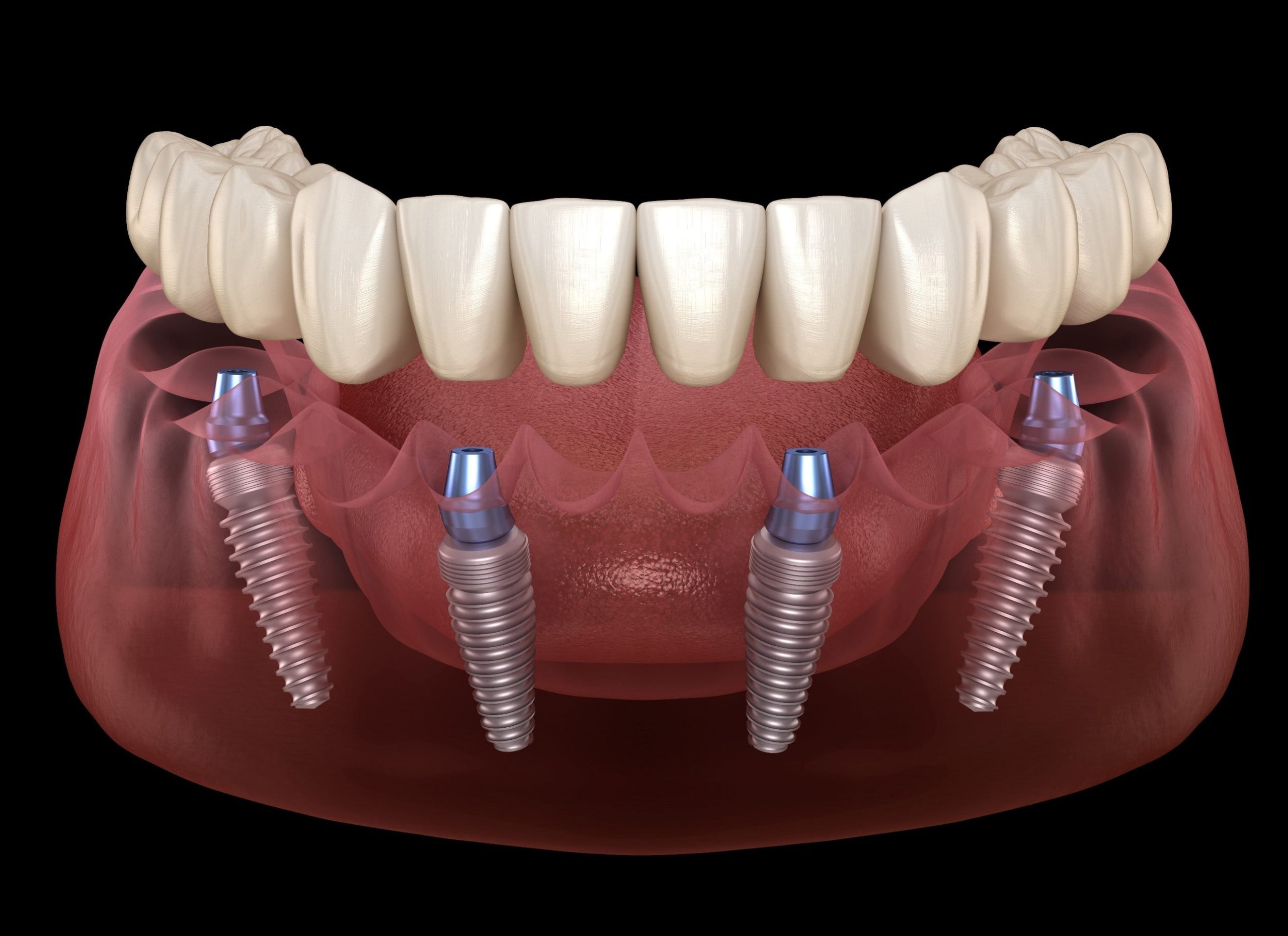 Dental Implants - Kensington Court Clinic -All on 4 dental implants (2)-min