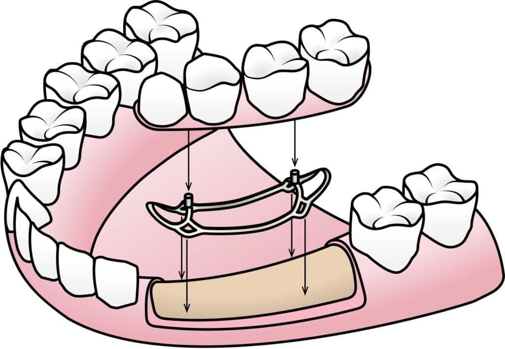 Dental Implants - Kensington Court Clinic - Subperiosteal Implants