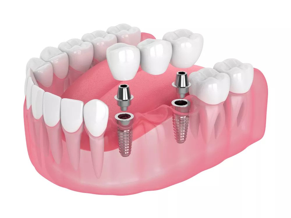 Dental Implants - Kensington Court Clinic - implant supported bridge