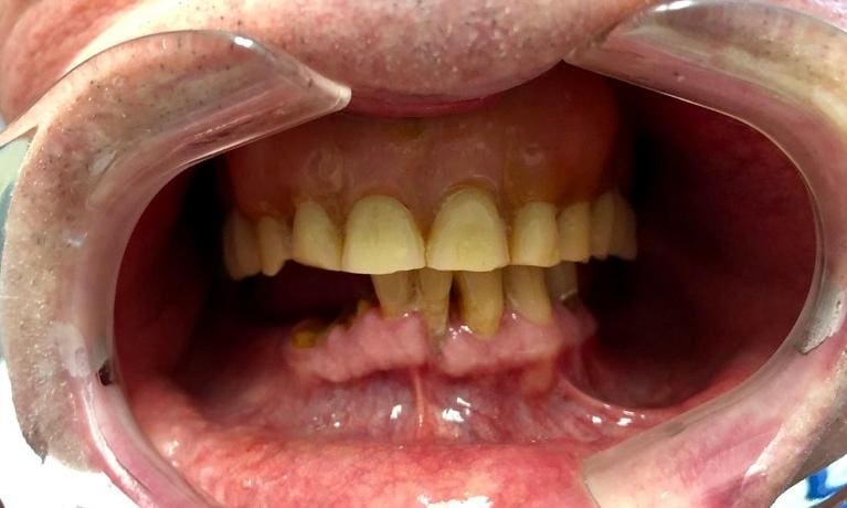 Dentures - Kensington Court Clinic - full denture before treatment