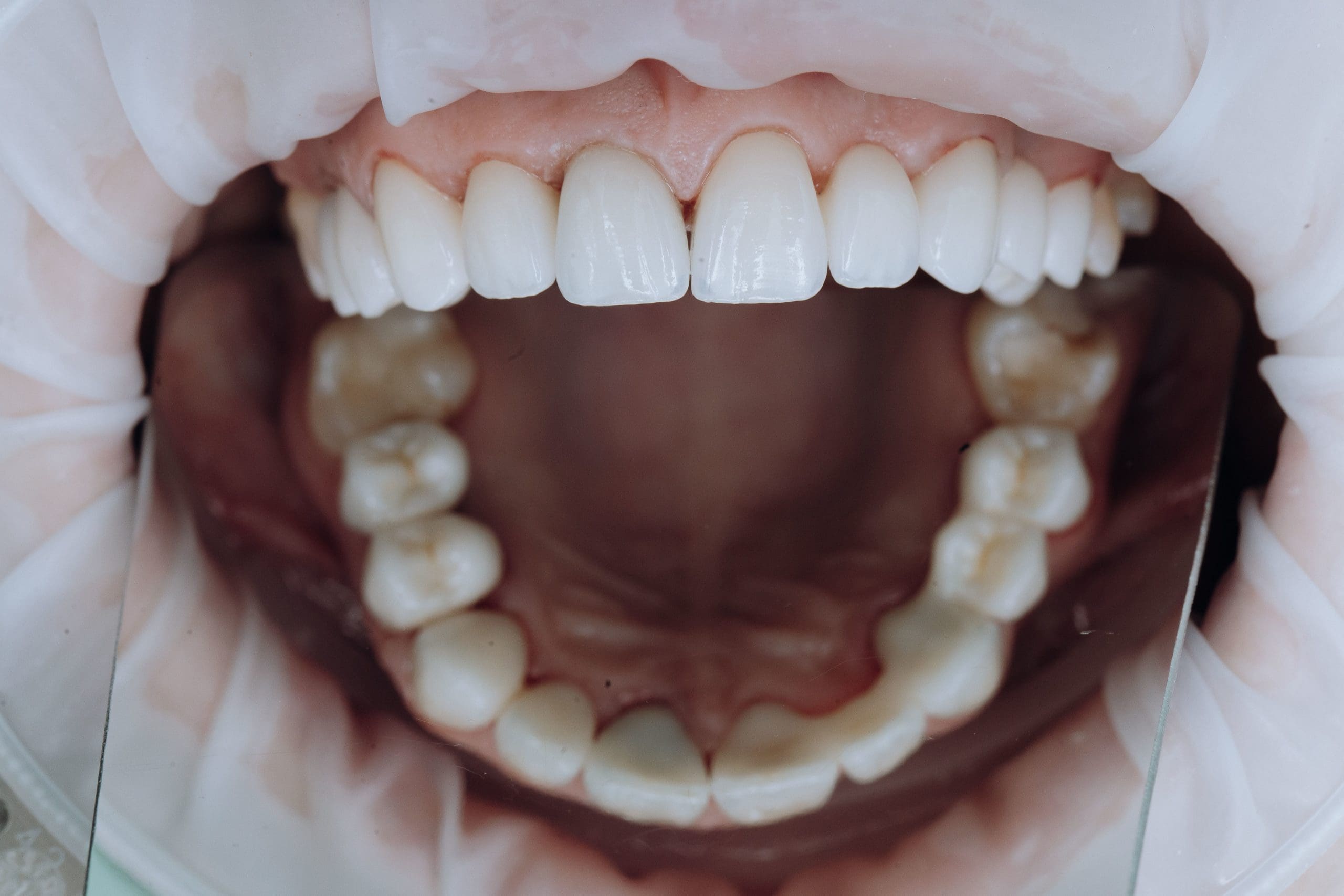 White Fillings – Kensington Court Clinic -bright white smile – what are fillings White Fillings - Kensington Court Clinic -bright white smile - what are fillings