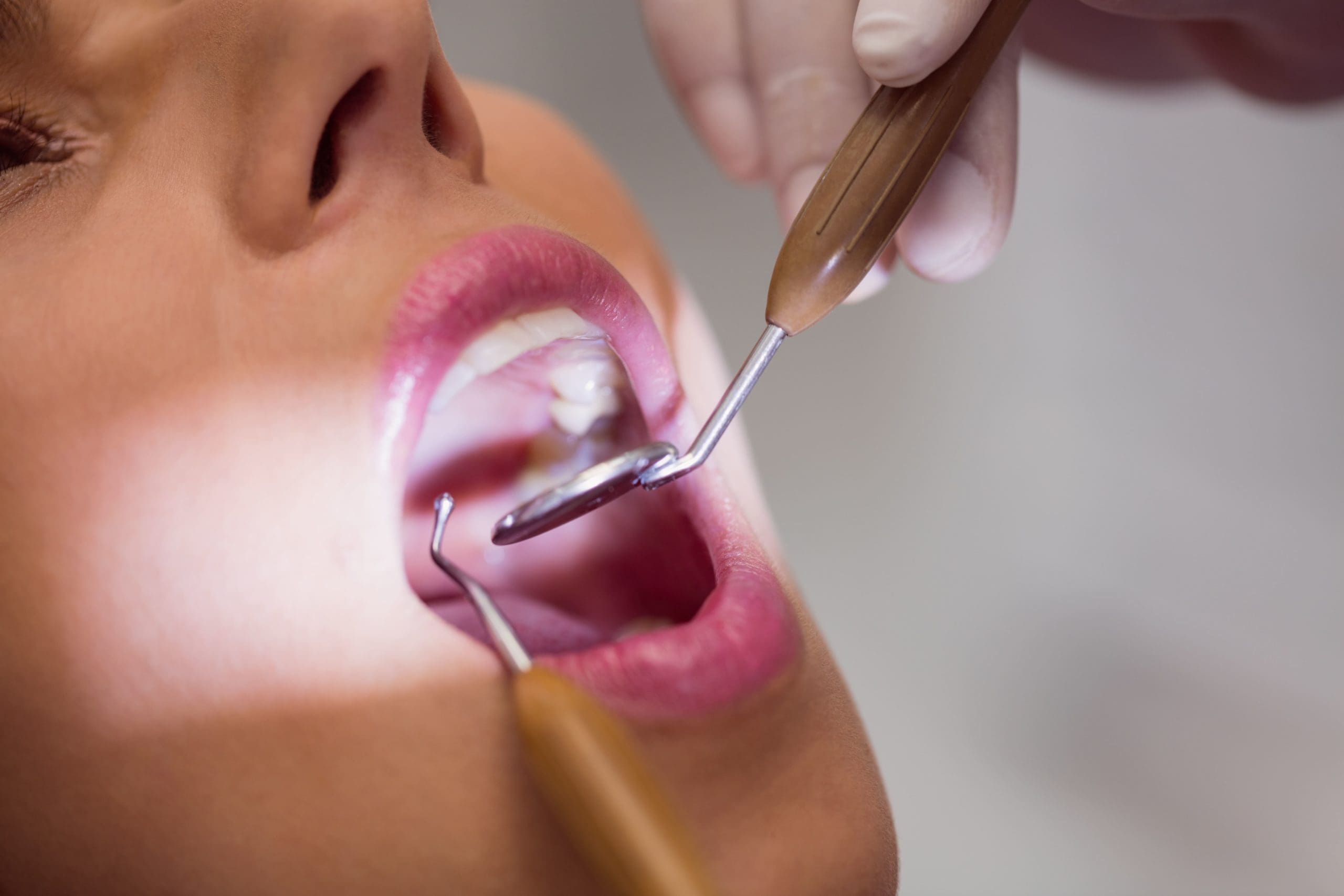 White Fillings – Kensington Court Clinic -bright white smile – What are the Advantages Of Tooth-Coloured Fillings? White Fillings - Kensington Court Clinic -bright white smile - What are the Advantages Of Tooth-Coloured Fillings?