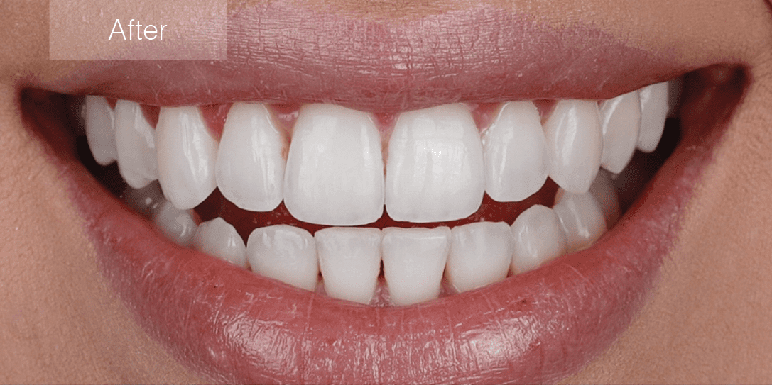 KCC Invisalign After Image