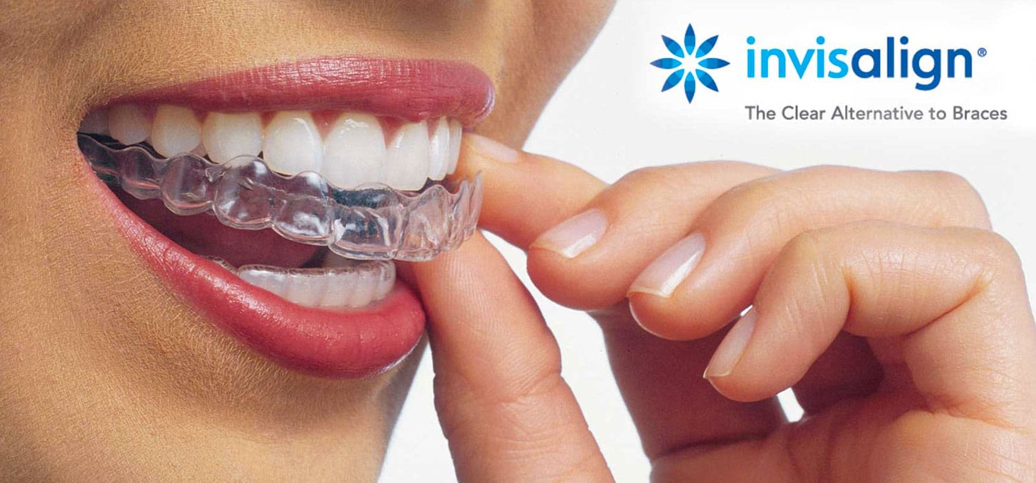 Invisalign Clear Braces - Kensington Court Clinic