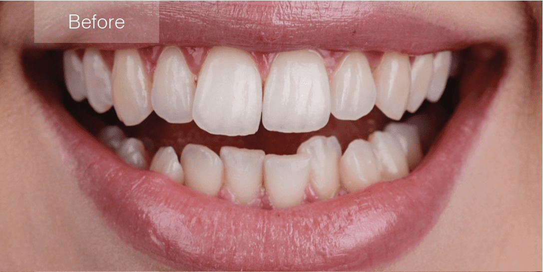 KCC invisalign Before