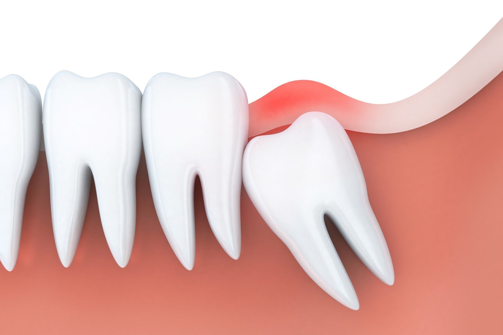 Wisdom Teeth Removal - Kensington Court Clinic - demo of wisdom teeth impacted - top image
