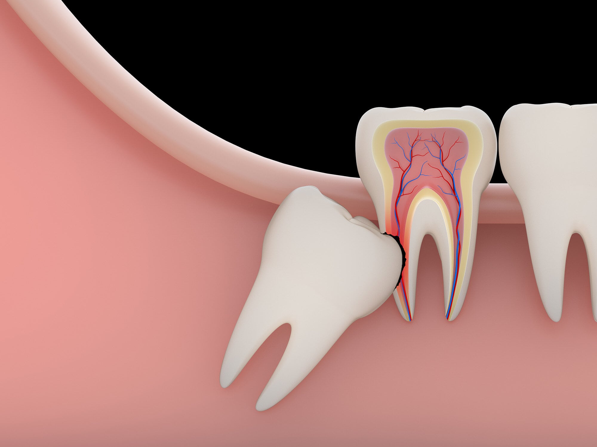 Wisdom Teeth Removal - Kensington Court Clinic - impacted wisdom teeth